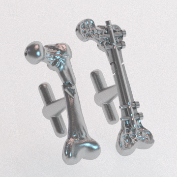 image of femur fracture cufflinks by Michelle Davis